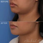 Buccal Fat Removal Before and After Photo by Dr. Foulad in Beverly Hills California