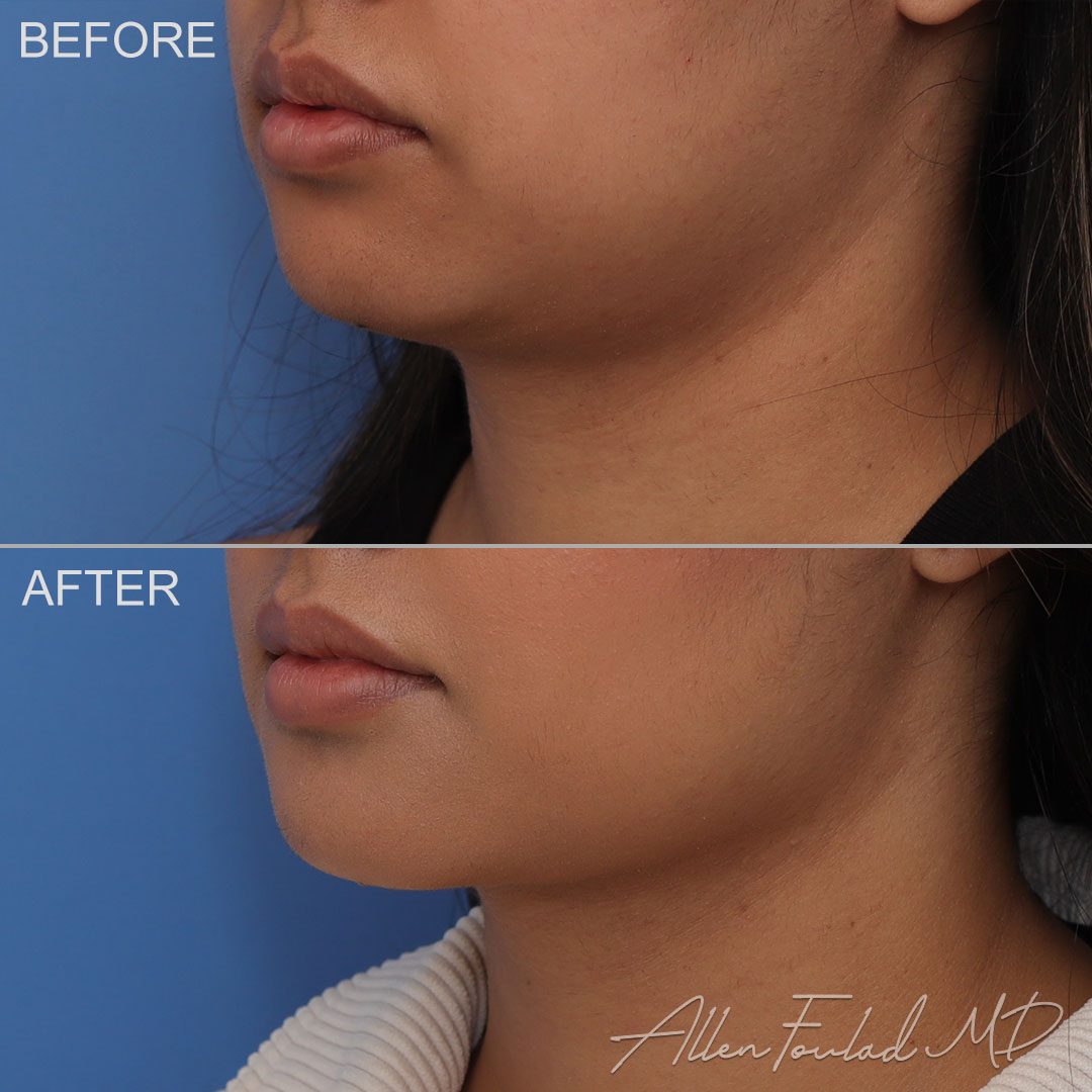 buccal-fat-reduction-5-revision-liposuction-neck-lower-face-lo