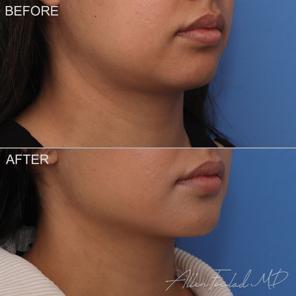 Buccal Fat Removal Before and After Photo by Dr. Foulad in Beverly Hills California