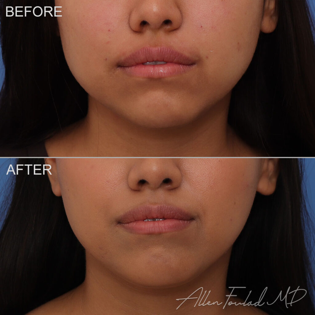 Buccal Fat Removal Before and After Photo by Dr. Foulad in Beverly Hills California