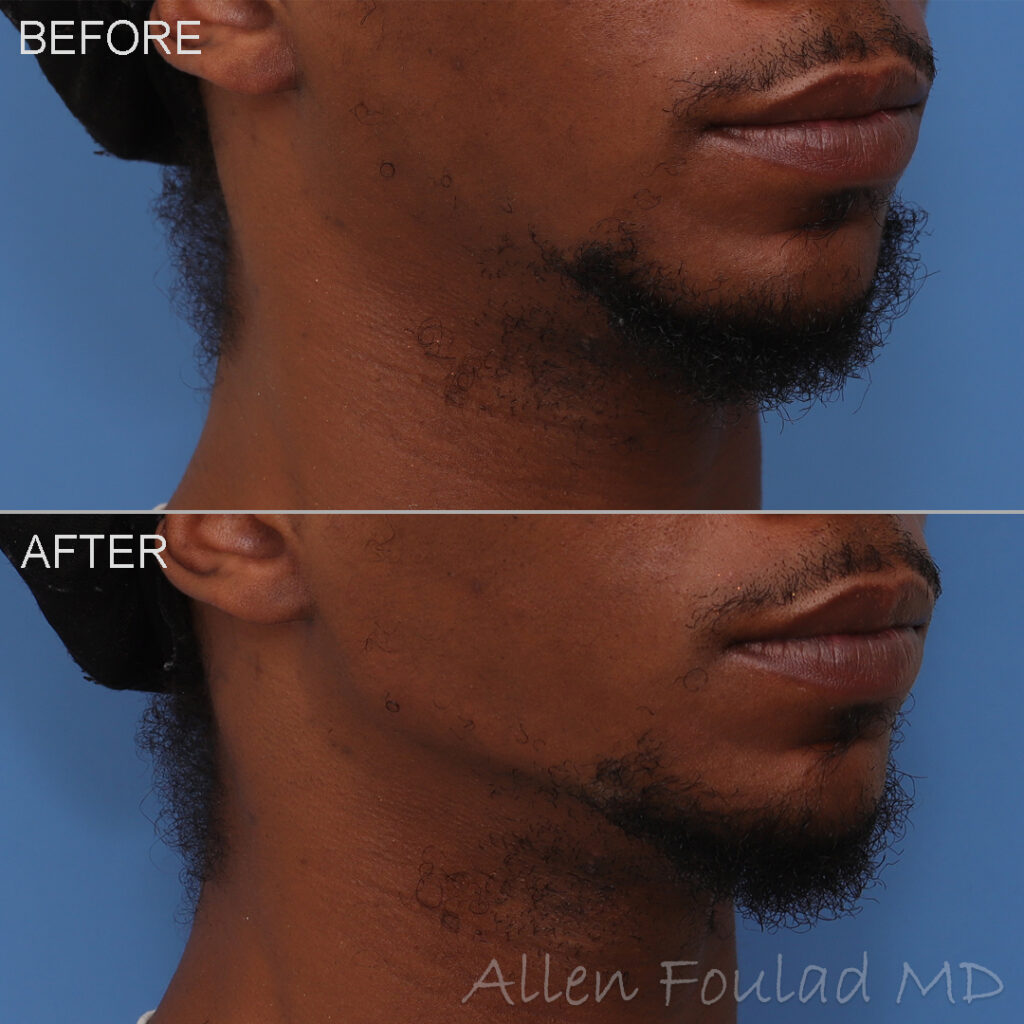 Filler Before and After Photo by Dr. Foulad in Beverly Hills California