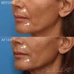 Filler Before and After Photo by Dr. Foulad in Beverly Hills California