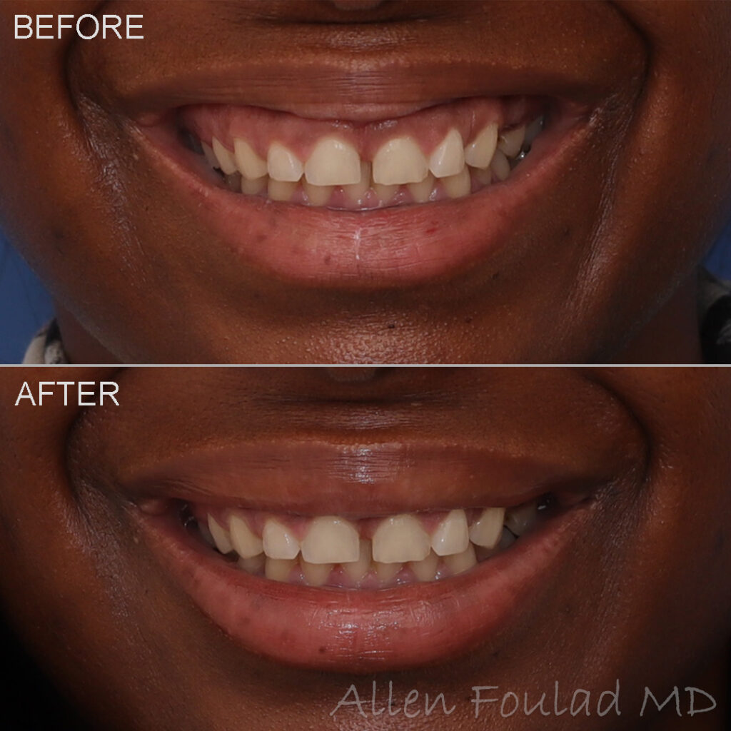 Neuromodulators Before and After Photo by Dr. Foulad in Beverly Hills California