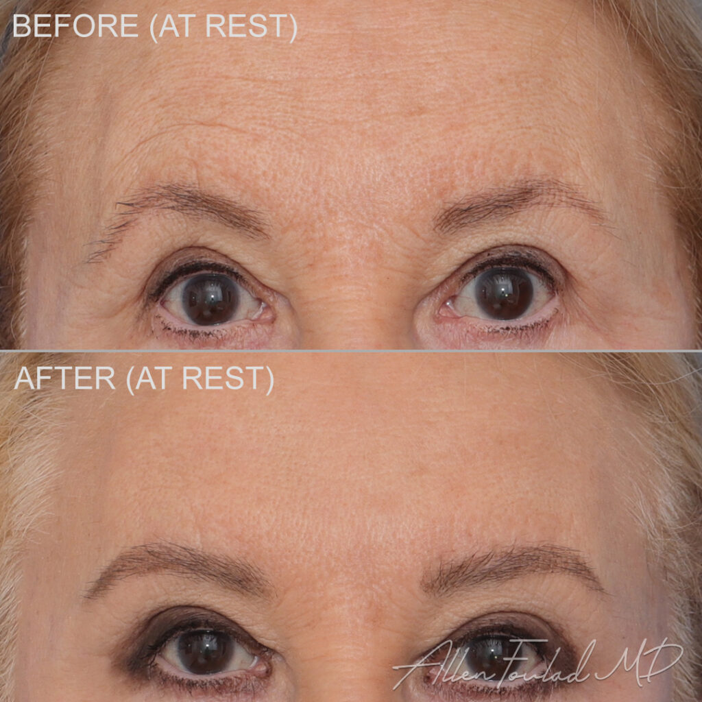 Neuromodulators Before and After Photo by Dr. Foulad in Beverly Hills California