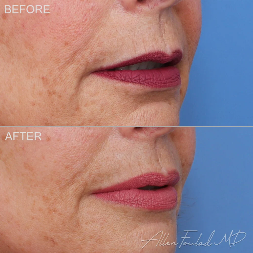 Filler Before and After Photo by Dr. Foulad in Beverly Hills California