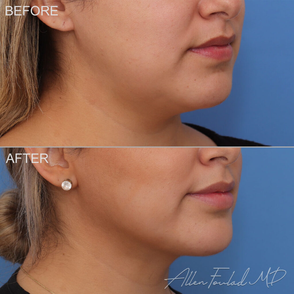 Liposuction – Neck & Face Before and After Photo by Dr. Foulad in Beverly Hills California