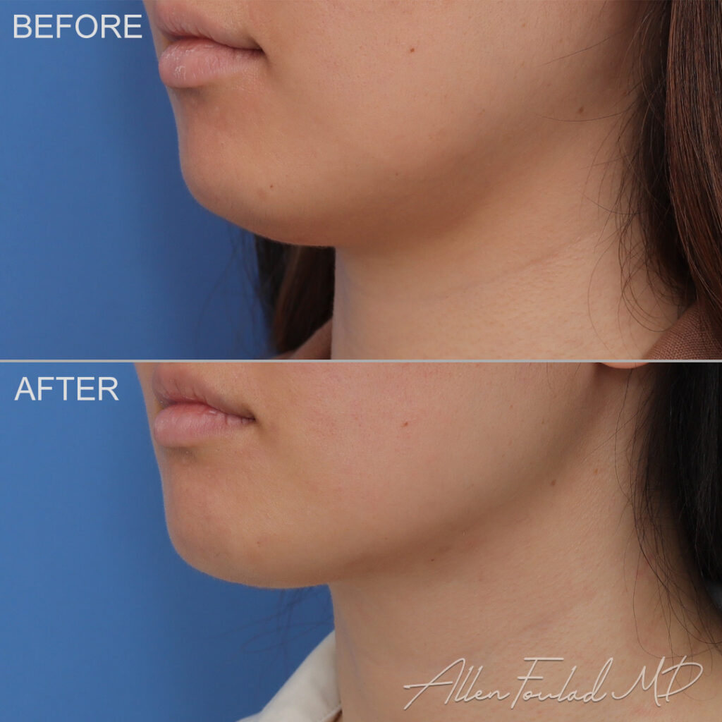 MIDS Neck Lift Before and After Photo by Dr. Foulad in Beverly Hills California
