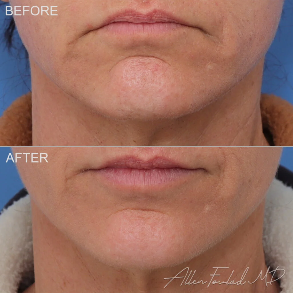 Botox Before and After Photo by Dr. Foulad in Beverly Hills California Botox Before and After Photo by Dr. Foulad in Beverly Hills California