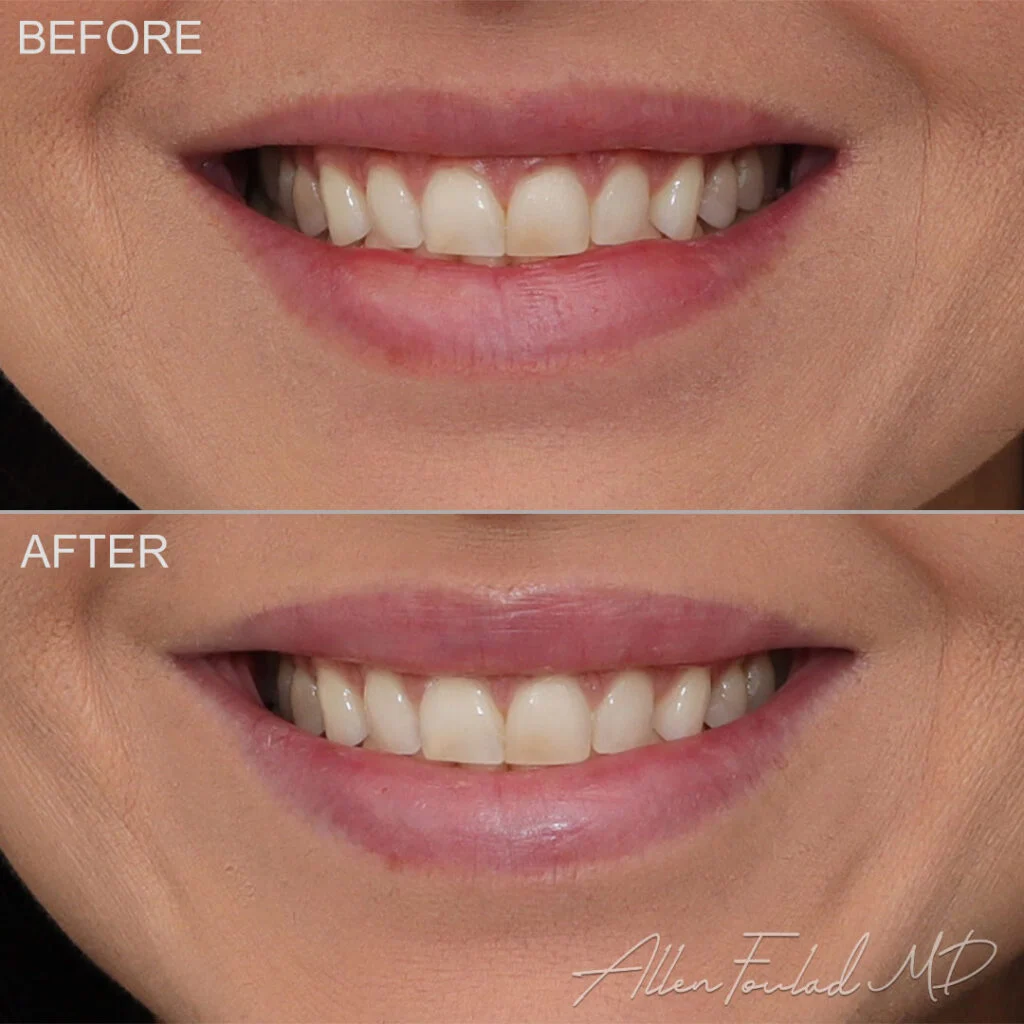 Botox Before and After Photo by Dr. Foulad in Beverly Hills California Botox Before and After Photo by Dr. Foulad in Beverly Hills California