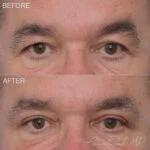 Upper Blepharoplasty Before and After Photo by Dr. Foulad in Beverly Hills California