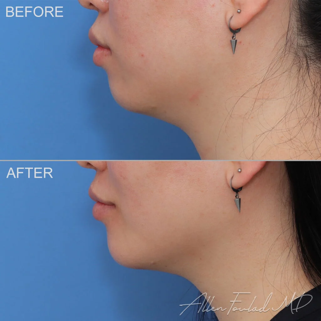 Chin Implant Before and After Photo by Dr. Foulad in Beverly Hills California Chin Implant Before and After Photo by Dr. Foulad in Beverly Hills California