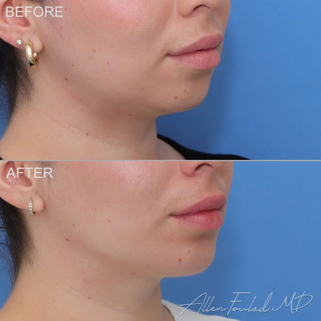 Chin Implant Before and After Photo by Dr. Foulad in Beverly Hills California Chin Implant Before and After Photo by Dr. Foulad in Beverly Hills California