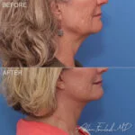 Facelift & Neck Lift Before and After Photo by Dr. Foulad in Beverly Hills California