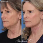 Facelift & Neck Lift Before and After Photo by Dr. Foulad in Beverly Hills California