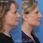 Facelift & Neck Lift Before and After Photo by Dr. Foulad in Beverly Hills California