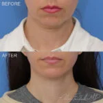 Facelift & Neck Lift Before and After Photo by Dr. Foulad in Beverly Hills California