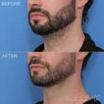 Before & After (id-1137) – MIDS Neck Lift™
