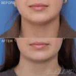 Before & After (id-1138) – MIDS Neck Lift™