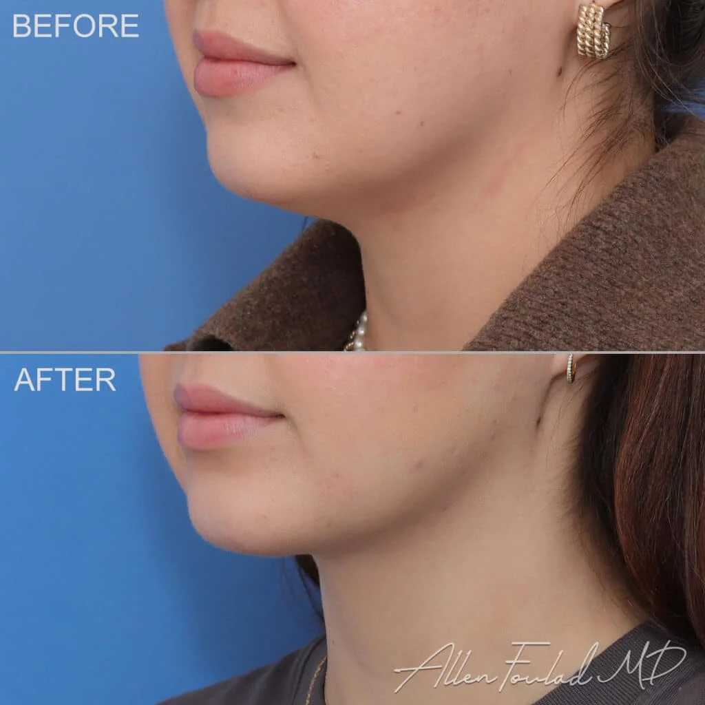 Before & After (id-1138) – MIDS Neck Lift™ Before and after MIDS Neck Lift™, on female patient.