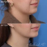 Before & After (id-1138) – MIDS Neck Lift™