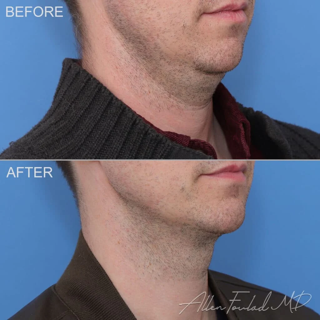 Before & After (id-1139) – MIDS Neck Lift™ Before and after MIDS Neck Lift™, on male patient.
