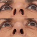 rhinoplasty-9-b