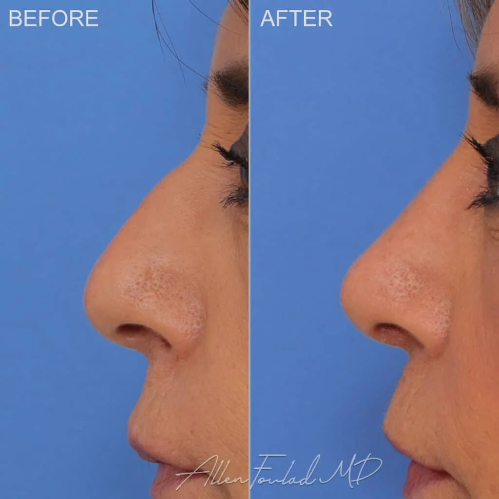 Before and after rhinoplasty, on female patient.