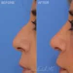 rhinoplasty-9-lp