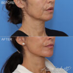 facelift-necklift-22-ro