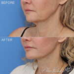facelift-necklift-24-co2-lo
