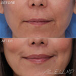 liplift-2-f