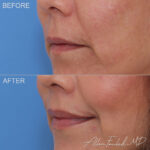 liplift-2-lo