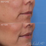 liplift-2-ro