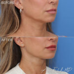 necklift-minimal-incision-deep-12-ro