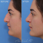 rhinoplasty-10-lp