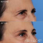 brow-lift-2-ro