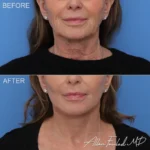 facelift-necklift-27-co2-f