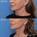 facelift-necklift-27-co2-lo
