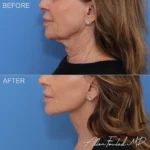 facelift-necklift-27-co2-lp