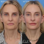 facelift-necklift-28-browlift-co2-f