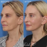 facelift-necklift-28-browlift-co2-lo