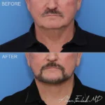 facelift-necklift-revision-26-buccal-fat-f