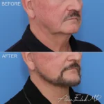 facelift-necklift-revision-26-buccal-fat-ro