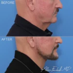 facelift-necklift-revision-26-buccal-fat-rp