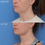 necklift-minimal-incision-deep-13-lo