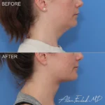 necklift-minimal-incision-deep-13-rp