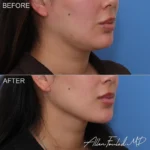 necklift-minimal-incision-deep-14-ro