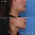 necklift-minimal-incision-deep-14-rp