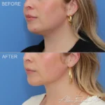 necklift-minimal-incision-deep-15-lo