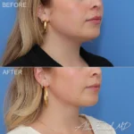 necklift-minimal-incision-deep-15-ro